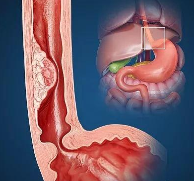 Lancet Gastroenterol Hepatol：晚期食管癌患者置入食管支架后是否有必要进行姑息性放疗？
