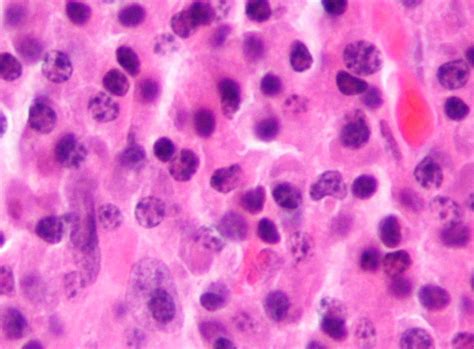 CHMP建议批准Sarclisa（isatuximab）与卡非佐米和地塞米松联合治疗复发性多发性骨髓瘤