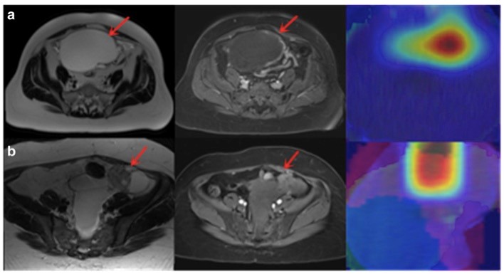 <font color="red">Eur</font> Radiol：卵巢肿瘤MRI诊断知多少？
