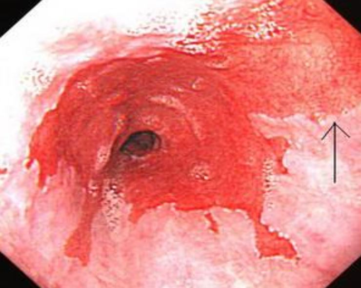Gastrointest Endosc：Barrett食管发展成食管<font color="red">肿瘤</font>的<font color="red">风险</font>！