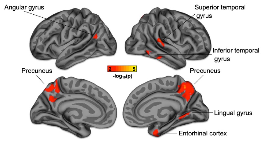 Alzheimer's dementia: 哈佛大学发现：具有痴呆症遗传风险者，神经丝轻链蛋白<font color="red">明显</font>升高