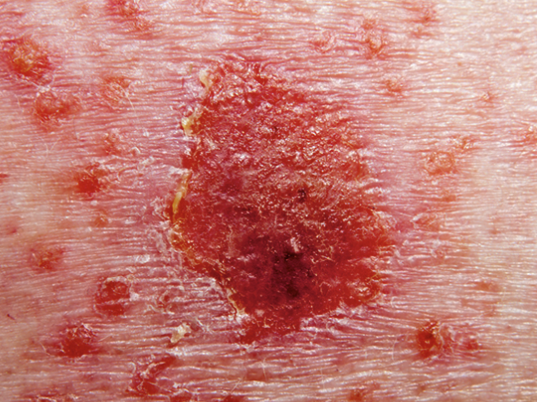 什么是副银屑病？它会进展成皮肤淋巴瘤吗？_糠疹