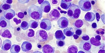 NEJM：<font color="red">Ide-cel</font>治疗复发性多发性骨髓瘤患者II期临床获得成功