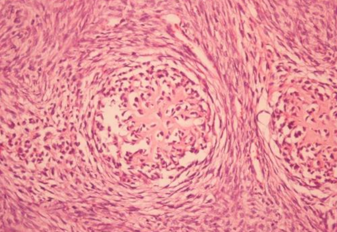 Cell Death Differ：GLI1通过mTOR/S6K1信号级联反应介导软骨肉瘤的发生发展