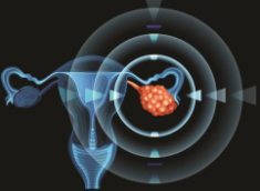 Lancet oncol：二次减瘤术对于<font color="red">铂</font>敏感的复发性卵巢癌到底有无益处？