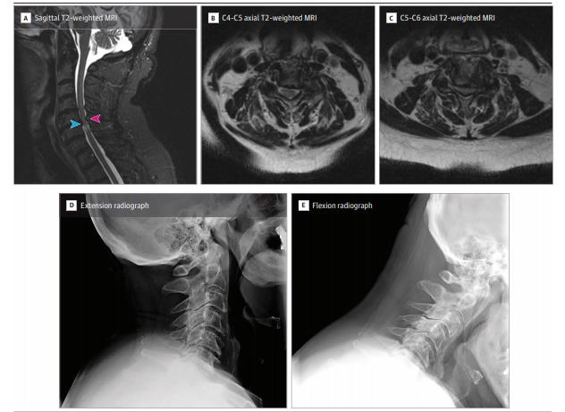 JAMA：<font color="red">腹</font>侧 vs 背侧手术入路对脊髓型颈椎病患者术后身体功能的影响