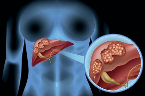 Gut：非酒精性脂肪性肝病患者的胃肠道癌症风险增加高达2倍！