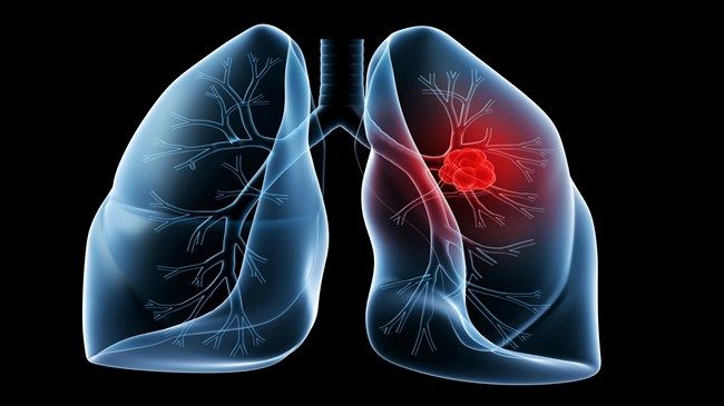 JAMA：肺癌筛查扩大范围