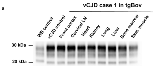 Acta Neuropathologica: <font color="red">朊病毒</font>在vCJD和sCJD患者外周组织中广泛分布
