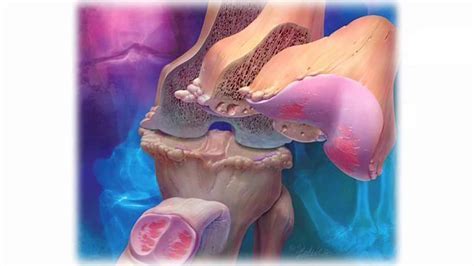 刺激膝关节软骨再生！FDA允许开展人类细胞外基质HST-003的I/II期试验