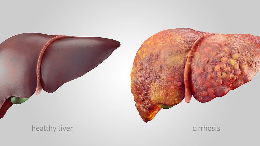 GUT: 饮食中的<font color="red">胆固醇</font>通过调节肠道菌群和<font color="red">代谢</font>产物来促进脂肪肝相关的肝癌的发生