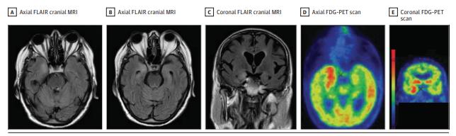JAMA Neurol：免疫检查点抑制剂相关脑炎特征研究