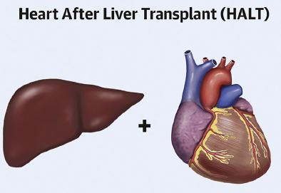 JACC：肝移植后心脏移植可减轻致敏患者的心脏移植排斥反应！