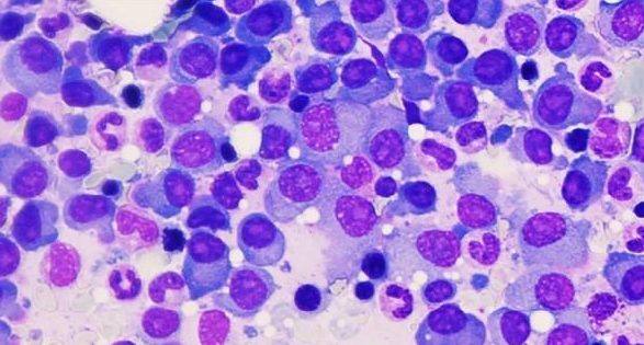 Blood：免疫抑制下发生的EBV相关原发性CNS<font color="red">淋巴瘤</font>是一种独特的疾病