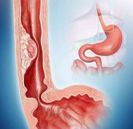 Int J Cancer：新辅助系统疗法对胃肠道间质瘤预后的影响