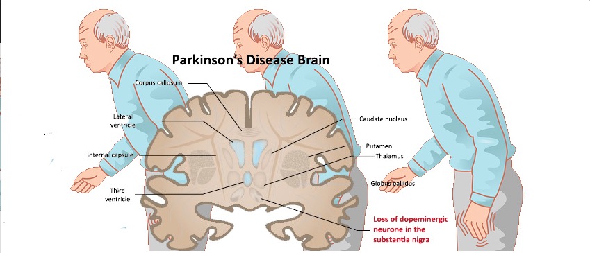 Neurology：血管周围空间可有效反映<font color="red">帕金森</font>的运动障碍