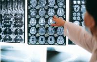 JAMA Neurol：健康儿童脑部磁共振偶然发现率及其临床意义