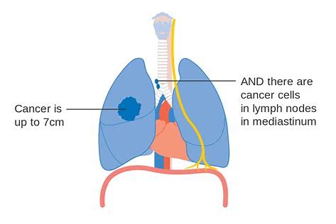 <font color="red">Tecentriq</font>一线治疗转移性非小细胞肺癌，CHMP持积极意见