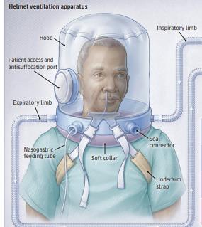 JAMA：头盔通气对新冠肺炎患者呼吸支持天数的影响