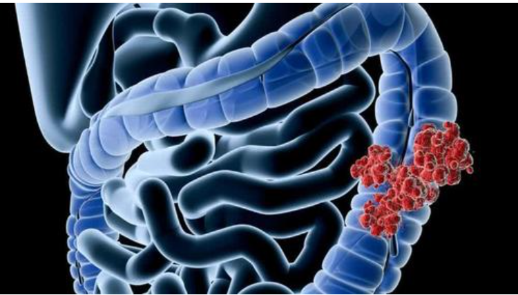 Br J Cancer：前瞻性研究揭示胆结石病与胃肠道癌发病风险的因果关系