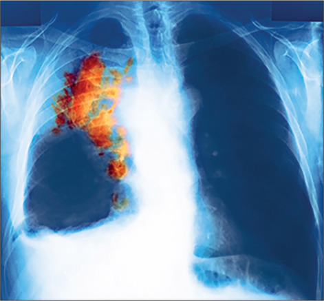 Lancet Oncology：<font color="red">局限期</font><font color="red">小</font>細胞<font color="red">肺癌</font>目前標準放療方案是否合理？