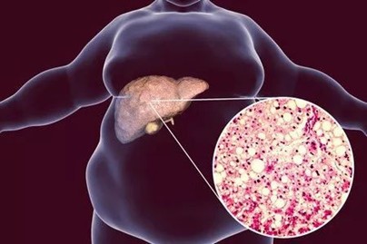 NEJM: 累及全球1/4人口，“明星药”索马鲁肽有效改善脂肪肝进展！