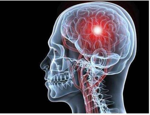J Neurochem:脑血流连通性可作为皮质下卒中影像预后生物标志物