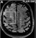BRAIN: <font color="red">7</font>T MRI检测MS铁环病变的长期演变