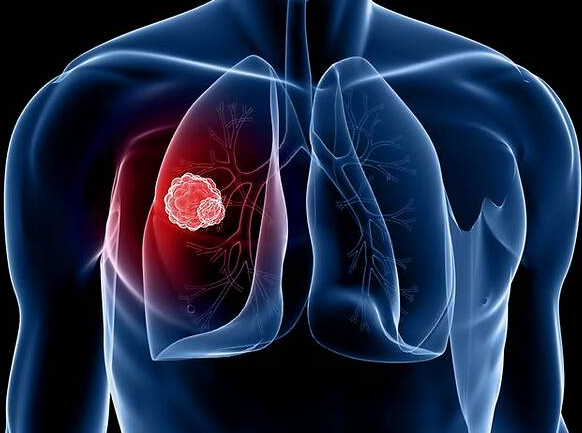 JTO：Rova-T联合纳武单抗或伊匹单抗治疗广泛期小细胞肺癌的疗效和安全性