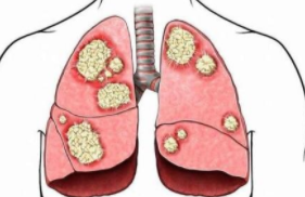 J Thorac Oncol：RovalPituzumab tesiine与拓扑替康用作小细胞肺癌二线治疗方案的疗效对比