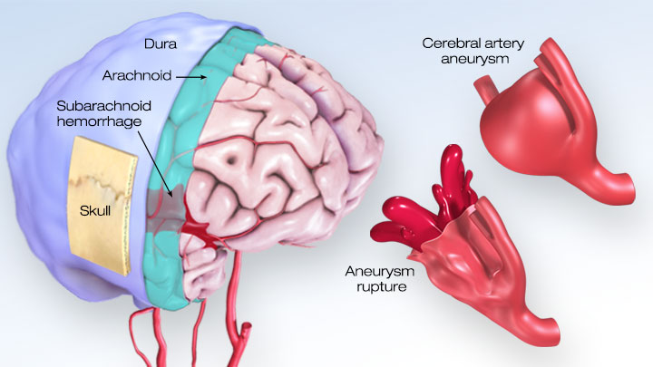 Brain：神经丝轻链蛋白，可有效预测蛛网膜下腔出血的临床预后