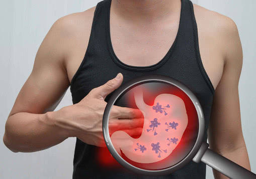 Gastric Cancer: 胃癌在患有萎缩性胃炎的林奇综合征患者中非常普遍