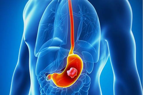 Gastric Cancer: PD-1抑制剂治疗的微卫星稳定性胃癌患者少肌症的疗效分析