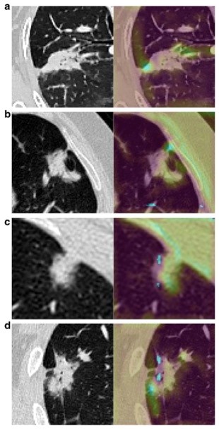 Eur Radiol:如何判断肺癌有没有侵犯脏层胸膜？
