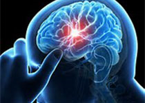 Stroke：脑淀粉样血管病患者枕叶皮质钙化