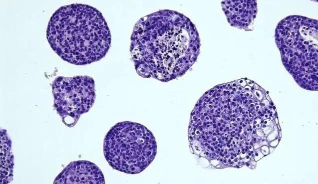 Cell Stem Cell：首个患者来源的宫颈癌类器官模型，为宫颈癌研究提供新手段
