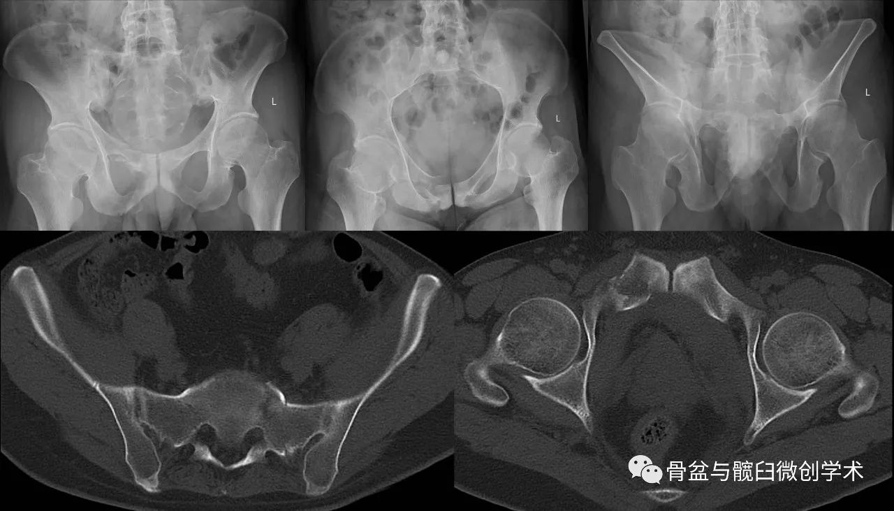 骶骨在s2以下的橫斷骨折a2後環完整,髂骨直接骨折a型(穩定型)a1後環