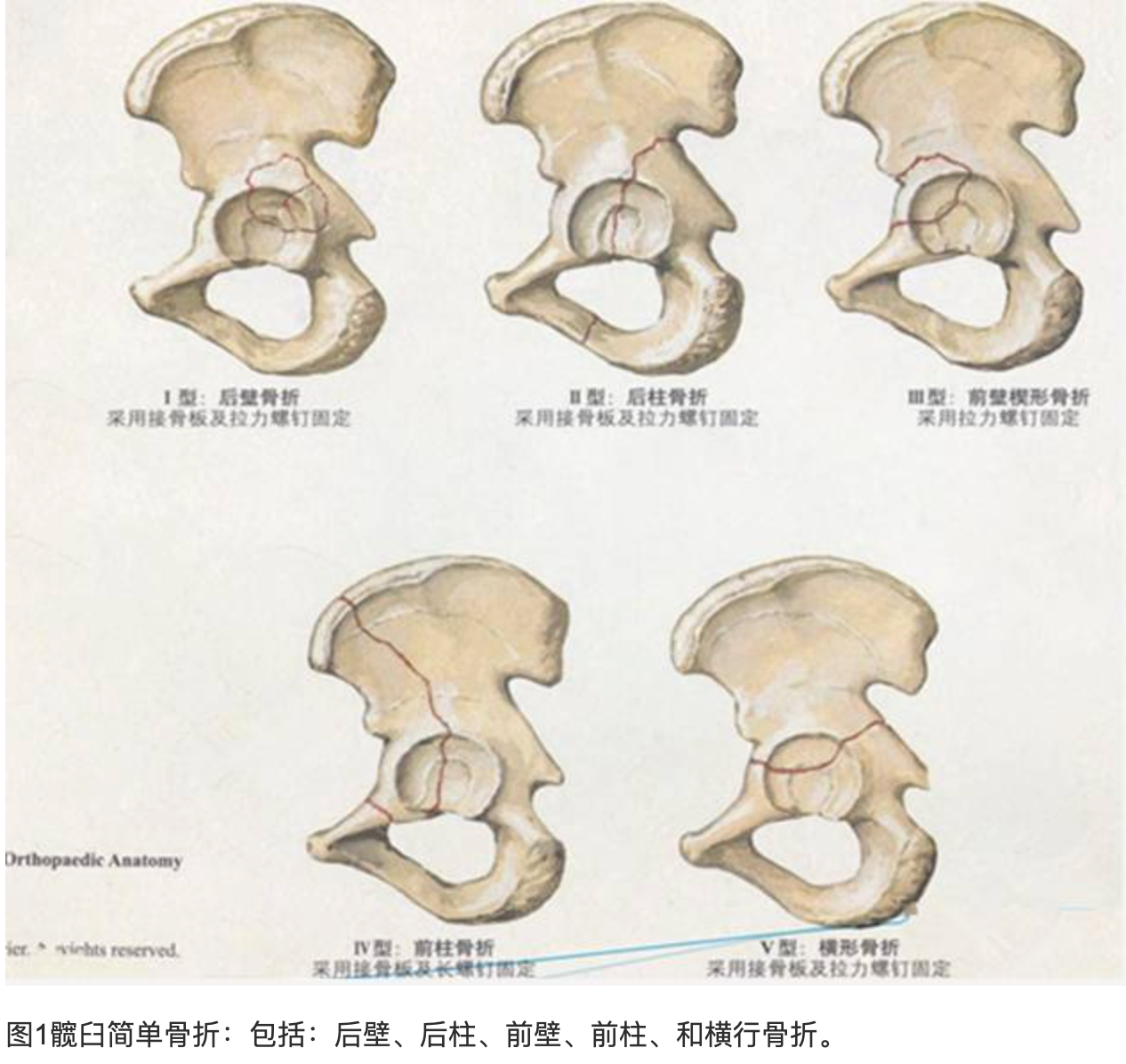 骨盆骨折分型tile图片图片