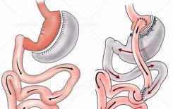 Circulation：缩胃手术可降低重度肥胖患者的多种心血管不良结局风险