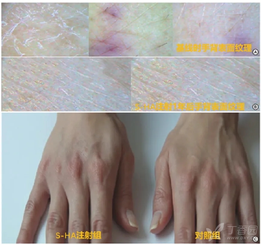 医美前沿解读 | Skinbooster韩国研究-改善皮肤<font color="red">质量</font>的证据
