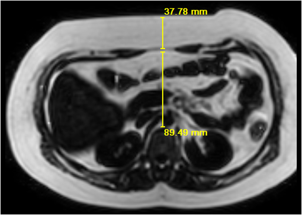 JAHA：单心室Fontan循环患者的肝脂肪变性分析