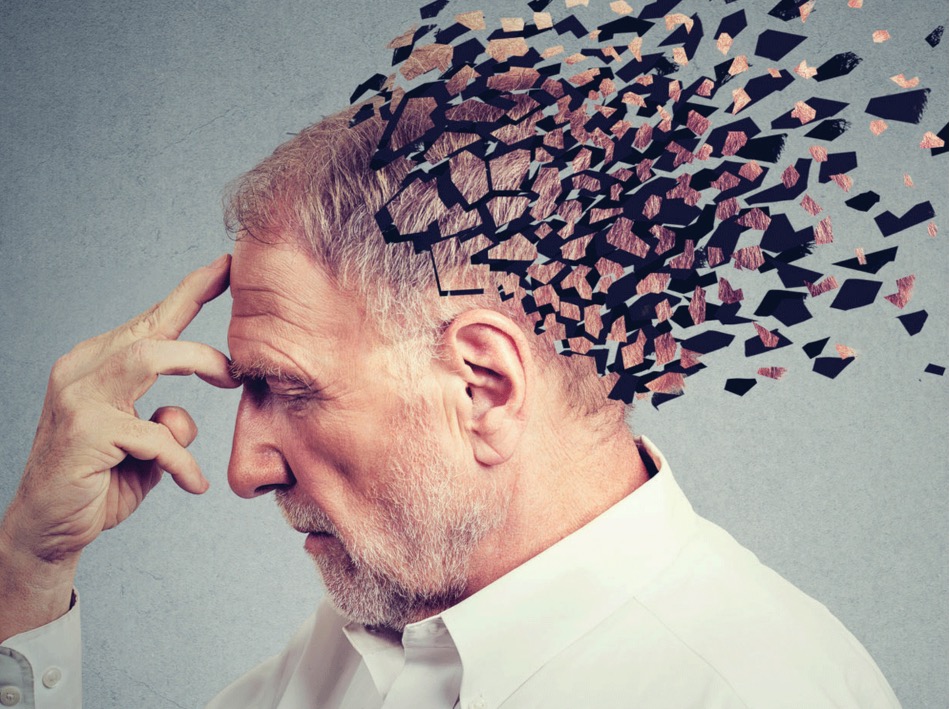 Alzheimer Dementia：锥体外系症状可有效预测痴呆风险