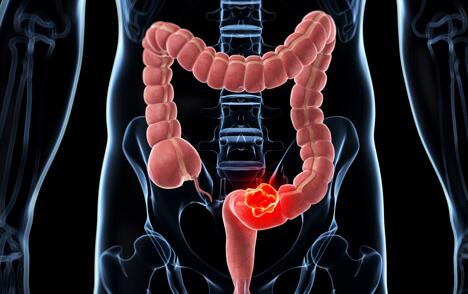 Clin Gastroenterology H: 结肠镜检查后腺瘤检出率和腺瘤特征与结直肠癌死亡率直接相关