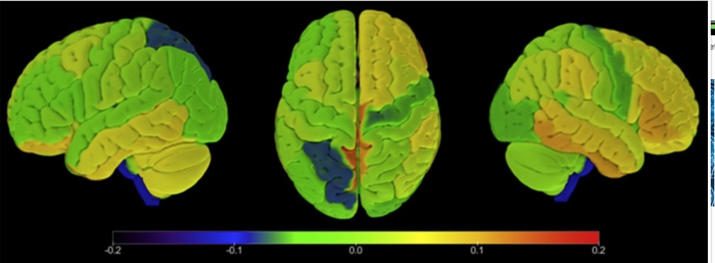 Neurology: 血液神经丝轻链蛋白，可有效筛查无症状的额颞<font color="red">叶</font>痴呆