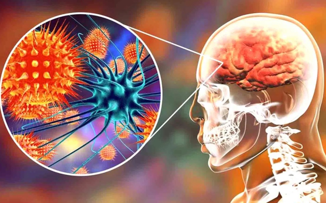 Neurology：脑脊液生物标记物，可有效预测自身免疫性<font color="red">脑炎</font>