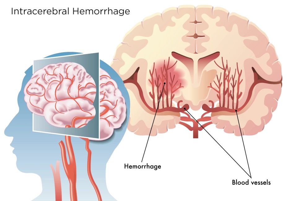 Neurology: 脑小血管疾病，可加剧脑内<font color="red">出血</font>者的不良预后