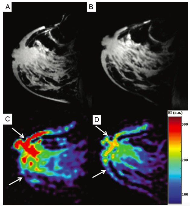 Radiology：乳腺癌患者的福音-7.0T MRI不再遥不可及
