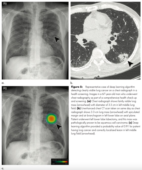 Radiology：用胸片筛查肺癌结节，你放心吗？人工智能给你答案！