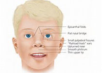 Ear Nose Throat J：突发感音神经性听力损失儿童的<font color="red">临床</font><font color="red">特征</font>与内淋巴水肿的相关性