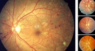 JAMA Ophthalmol：玻璃体内注射VEGF抑制剂阿柏西普对糖尿病<font color="red">视网膜</font>病变视力减退的预防作用